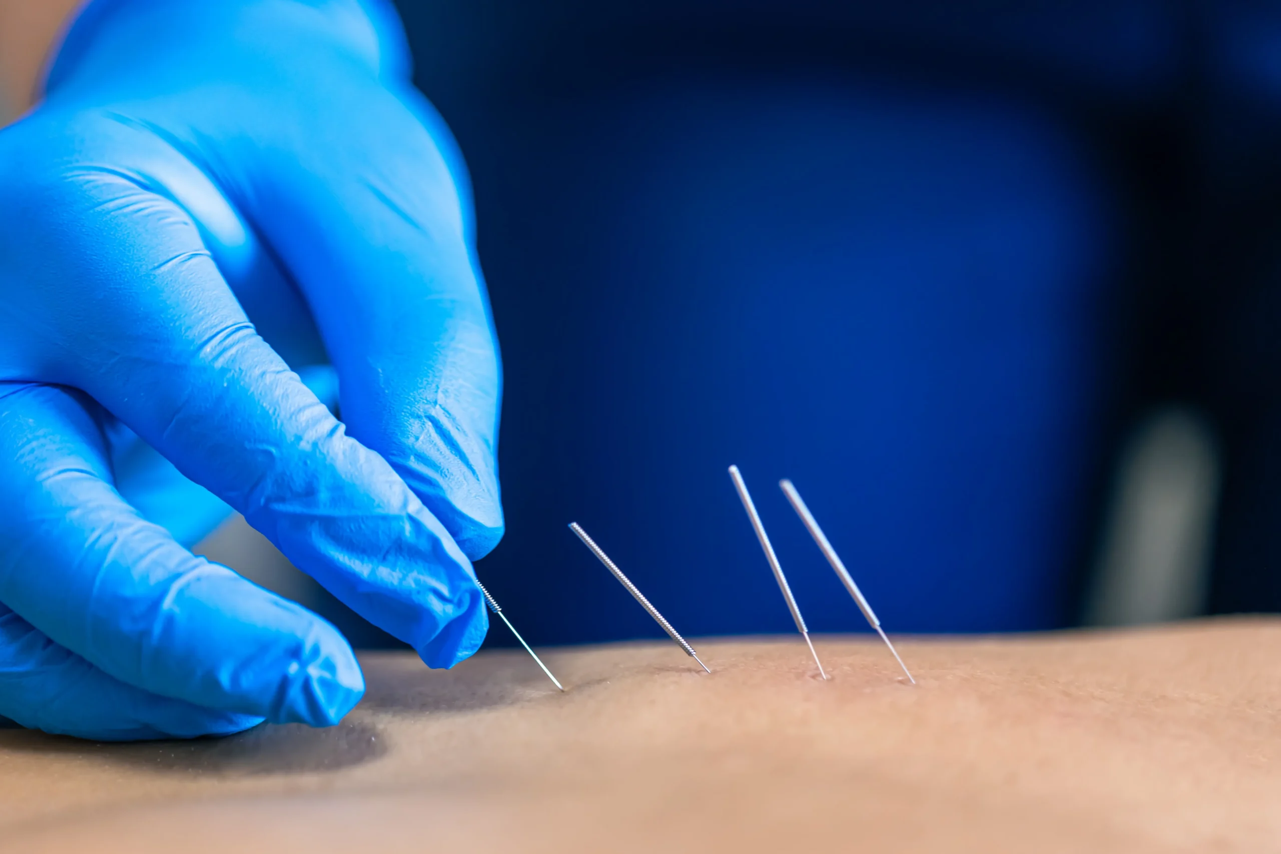 Close up of medical professional in sterile latex gloves applies dry needling to a patients' back.